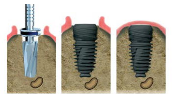 Spécialiste implant dentaire